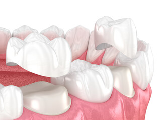 Porcelain crowns placement over premolar and molar teeth. 3D illustration