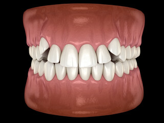 Impacted incisors, overcrowded teeth. Medically accurate 3D illustration of abnormal dental occlusion
