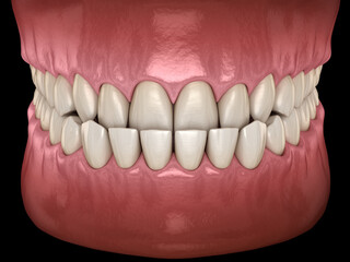 Underbite dental occlusion ( Malocclusion of teeth ). Dental 3D illustration