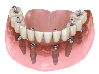 Mandibular prosthesis with gum All on 6 system supported by implants. 3D illustration