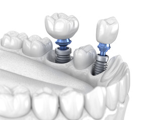 Premolar and Molar tooth crown installation over implant - white concept. 3D illustration of human teeth and dentures