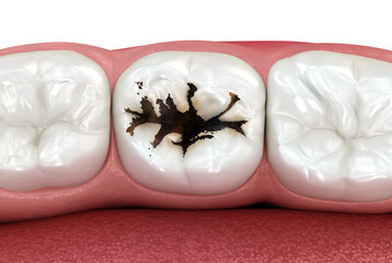 Molar teeth damaged by caries. Medically accurate tooth 3D illustration.