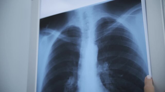 Doctor examining chest X-ray image on lightbox