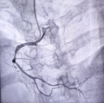 Coronary angiogram or CAG of right coronary artery during cardiac catheterization with dye. Findings mid RCA 60%-70% blocked. 