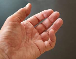 Hand of a person with Dupuytren's contracture - a condition in which one or more fingers become permanently bent in a flexed position. Here the little finger, causing it to bend towards the palm.