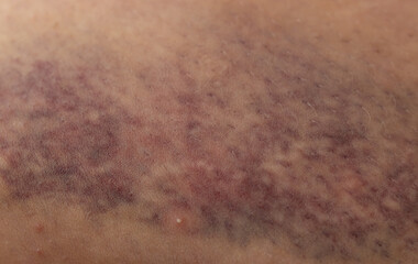 A person's leg has a bruise on it