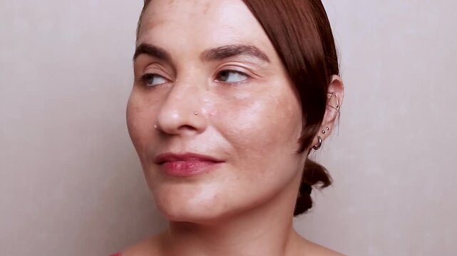 Woman shows face with pigmentation, melasma, freckles, age spots photo. Close up footage