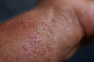 Fototapeta premium Close-up of sweaty skin with symptoms of a heat rash, also known as miliaria or sudamina, showing small red bumps and blisters caused by blocked sweat ducts