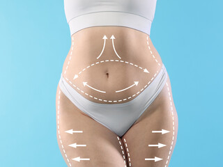 Liposuction. Woman showing her figure against light blue background, closeup. Markings on her body