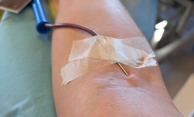 patients receiving an IV infusion with a needle at the city medical center