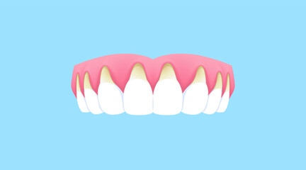 Upper teeth (Recession gums) illustration vector design. Dental care concept.