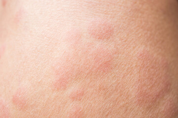 Skin allergy rash dermatitis texture close up background