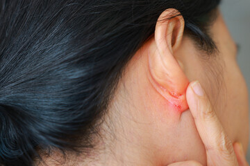 Close-up of skin infection behind the ear showing redness, inflammation, and irritation. Dermatological problem, eczema or fungal infection concept. Medical skincare issue.