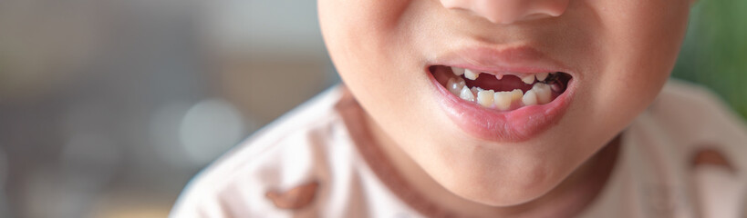Close-up of a child with missing teeth smiling, with a cute flying tooth cartoon character promoting fluoride protection and children's dental health care.