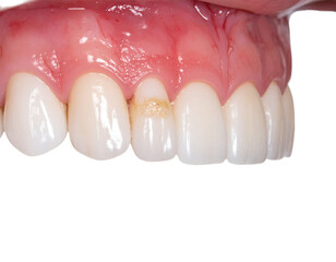 Fototapeta premium Close up of healthy white teeth and gums showing slight discoloration on one tooth, perfect for dental care.