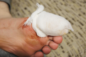 A bandaged toe on a man's foot.