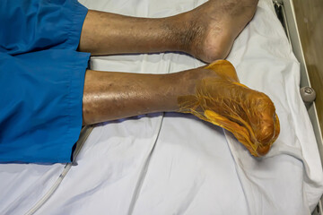 Close-up of a patient's foot and leg wrapped in yellow surgical film on a hospital bed.