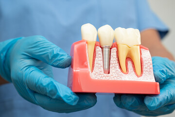 Dental implant, artificial tooth roots into jaw, root canal of dental treatment, gum disease, teeth...