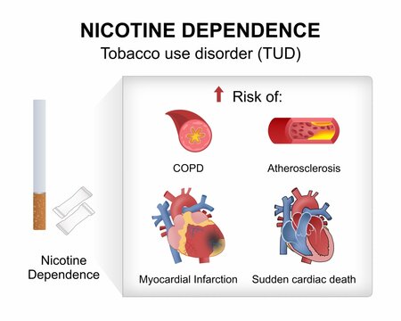 Nicotine Dependence - Tobacco use disorder (TUD)