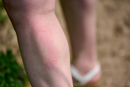 Red, irritated mosquito bite on calf. Shot outdoors on sunny day, with blurred path and grass background. Highlights discomfort and nature exposure
