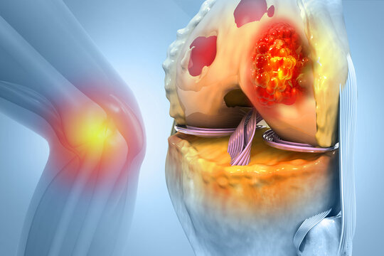 Bone cancer, knee joint, giant cell tumor of bone, osteosarcoma, 3d illustration