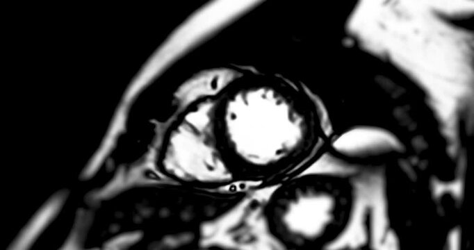 MRI heart stress test revealing detailed cardiac function under controlled conditions, aiding in early diagnosis and High-resolution imaging captures heart performance during stress.