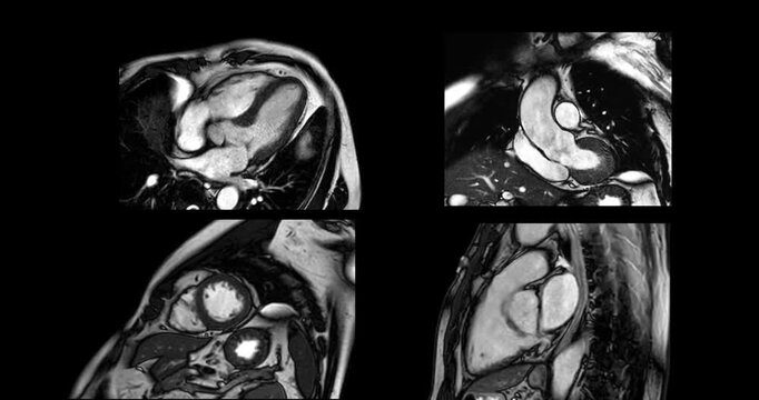 MRI heart stress test revealing detailed cardiac function under controlled conditions, aiding in early diagnosis and High-resolution imaging captures heart performance during stress.