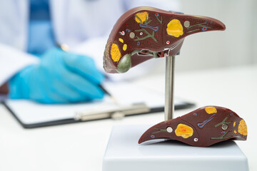 Cirrhosis, Liver cancer, fatty liver, Asian doctor with liver human anatomy model in World...