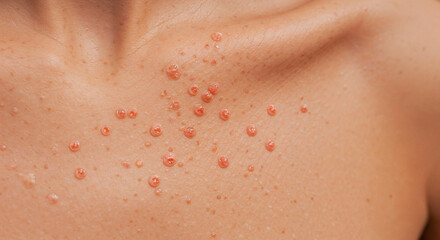 Fototapeta premium Skin with hives on chest showing raised welts and irritation 