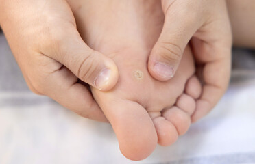 Child with callus on foot and toe lies on blanket. Parent applies adhesive bandage as treatment....