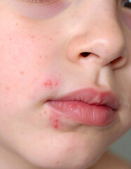 Obraz premium Hormones stimulate the sebaceous glands to produce excess oil, which, when combined with dead skin cells and other debris, can clog pores and lead to acne.