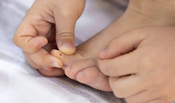 Child with callus on foot and toe lies on blanket. Parent applies adhesive bandage as treatment. Close-up of blister or corn care. Foot care and family support at home, natural light. - Powered by Adobe
