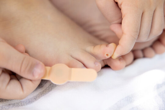 Child with callus on foot and toe lies on blanket. Parent applies adhesive bandage as treatment. Close-up of blister or corn care. Foot care and family support at home, natural light.