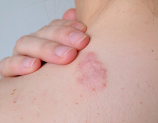 Fototapeta premium Realistic image of a woman touching a healed keloid scar on her collarbone