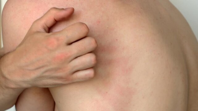 A man stands with his back to the camera and scratches his back.
Itching on the back of a young guy.
Dry skin and severe itching of the naked body