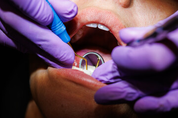 Dental scaling procedure for plaque removal, Close-up of a dentist performing dental scaling to remove plaque and tartar from a patient’s teeth using professional tools.

