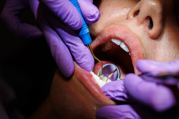 Dental scaling procedure for plaque removal, Close-up of a dentist performing dental scaling to...