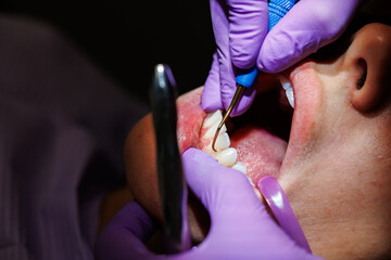 Dental scaling procedure for plaque removal, Close-up of a dentist performing dental scaling to...
