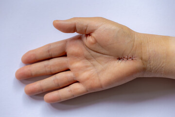 Selective focus of left hand with surgical wound suture after operation, Hand operation or surgery...