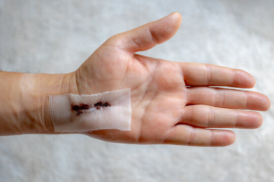 Selective focus of left hand with surgical wound suture after operation, Hand operation or surgery with carpal tunnel syndrome problem, Palm and fingers on white background, Heath and medical concept.