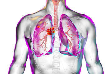 Primary lung tuberculosis, illustration