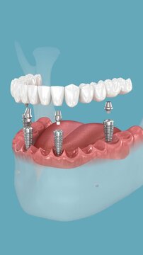Dental prostheses supported by 4 implants. 3D animation