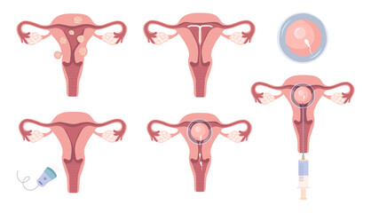 Female uterus. Common types of uterine fibroids,  fertilized egg. Educational medical diagram for use in infographics on gynecology, women's health, and the reproductive system. 