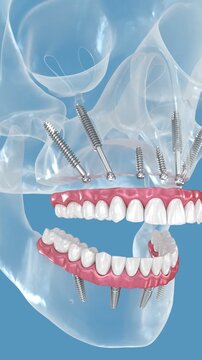 Dental prosthesis supported by zygomatic implants. 3D illustration