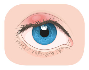 Eye with external barley on the upper eyelid. Medical vector illustration. 