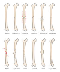 Bones with different fractures types. Medical vector illustration. 