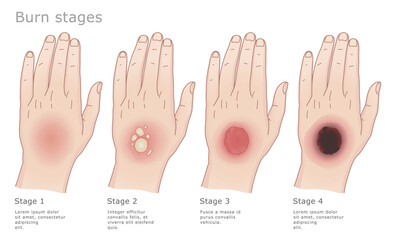 Four stages of the skin burns. Medical vector illustration. 