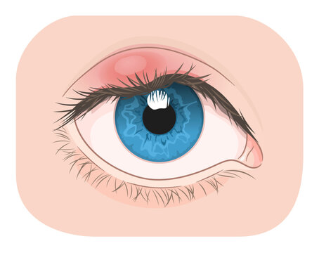 Eye with external barley on the upper eyelid. Medical vector illustration. 