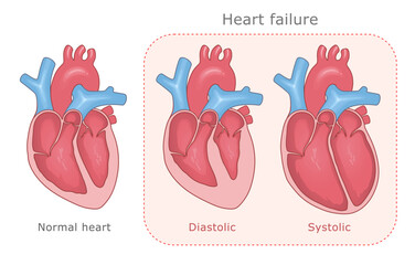 Normal heart and two types of heart failure: diastolic and systolic. Vector medical illustration.