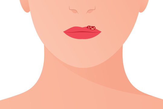 herpes simplex virus on the lips; contagious cold sore symptoms, lip blister, and viral skin infection great for educational, healthcare, and prevention purposes- vector illustration